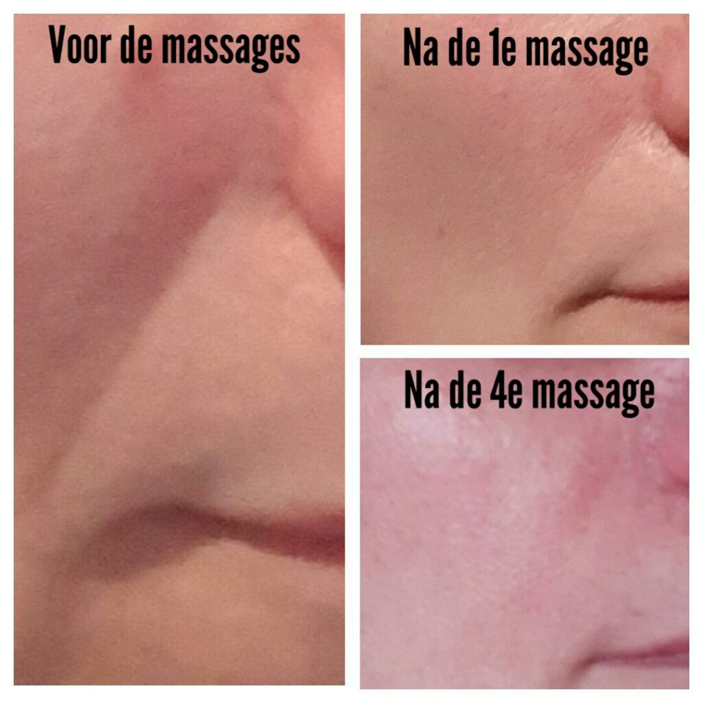 Voor en na foto's van de Anti-Aging massages