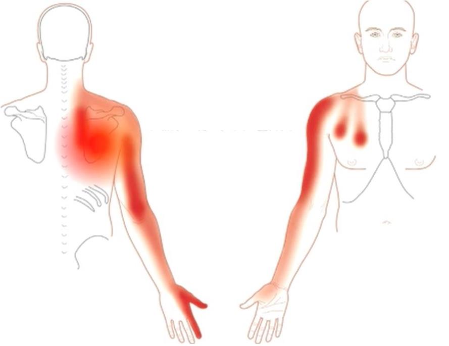 Tekening van pijngebieden in de borst, schouder, arm en hand bij spanning in de nek