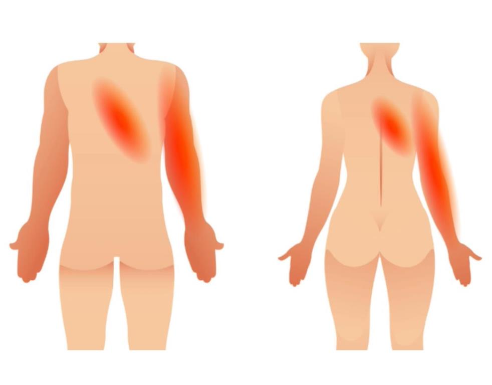 Pijngebieden triggerpoints Serratus superior